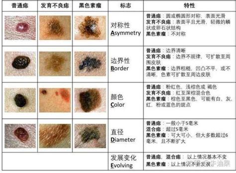 屁股長黑痣|痣是什麼？會變成黑色素瘤？7種一定要除的痣